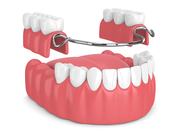 Denture: Partial & Complete